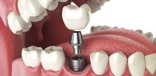 Dental Implants.jpg